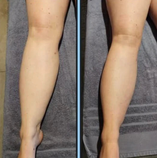 Colombian Lymphatic - Body Sculptor